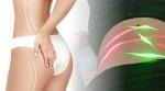 [SPECIJALNA PONUDA] Potpuna TRANSFORMACIJA tijela uz revolucionarni Maxlipo Master Slim LASER, Tesla uređaj, Butt Lift i presoterapiju u Bio+Klinik salonu u Zagrebu već od 49 €!