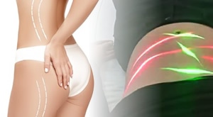 HIT ZA LJETO! 10x MAXLIPO ili BUTT LIFT + 10x presoterapija u Bio+Klinik Bukovac u ZAGREBU! Izaberite svoj paket za MRŠAVLJENJE i oblikovanje tijela od 20 tretmana za samo 199 € zablistajte na plaži!