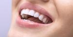 Dental studio Marić - čišćenje zubnog kamenca sa pjeskarenjem uz pregled